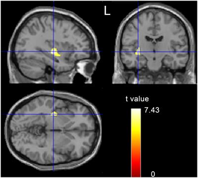 Altered Regional Gray Matter Volume in Obese Men: A Structural MRI Study